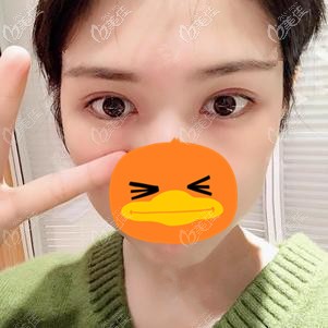 在福州格莱美做全切双眼皮术后半年