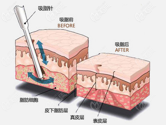 星灿宫张勇医生吸脂手术效果示意图 星灿宫张勇医生吸脂手术效果示意图