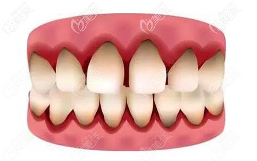 牙龈萎缩牙缝过大修复办法
