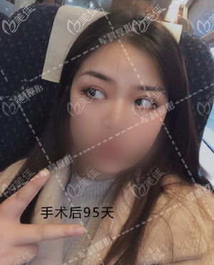 王科医生给我做完双眼皮3个月了