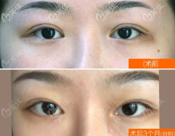 重庆军科双眼皮修复案例