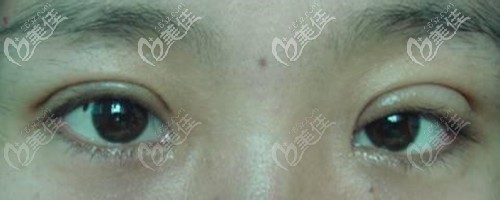 双眼皮过深不对称修复