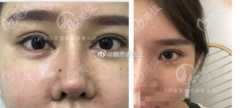 魏志香双眼皮过深修复案例