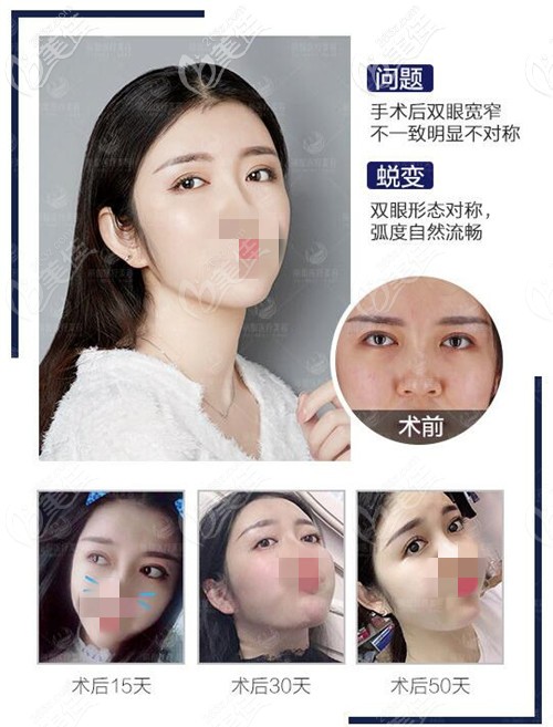 北京米兰柏羽丽都双眼皮不对称修复