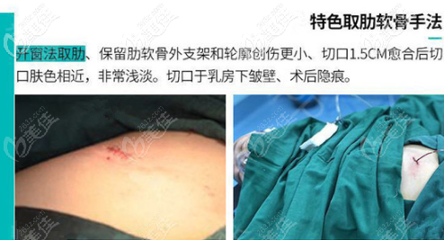 重庆军美特殊的肋软骨隆鼻手法