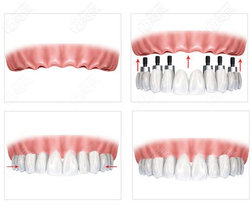 口腔做韩国进口登腾半口种植牙 口腔做韩国进口登腾半口种植牙
