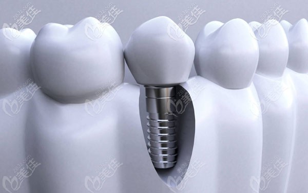 昆明竹子口腔韩国种植牙品牌及价格