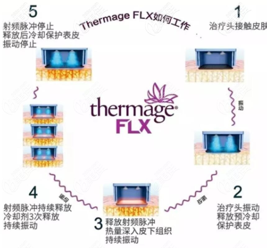 5代热玛吉工作原理及功效 5代热玛吉工作原理及功效