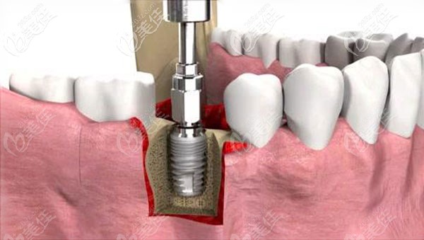 满口种植牙多少钱