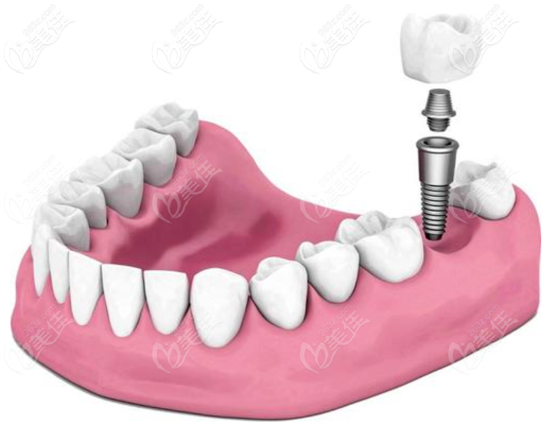 意大利BB种植牙优势