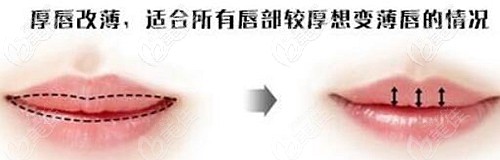 厚唇改薄手术的效果对比 厚唇改薄手术的效果对比