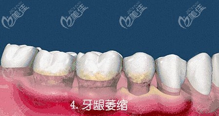 造成牙龈萎缩的重要原因