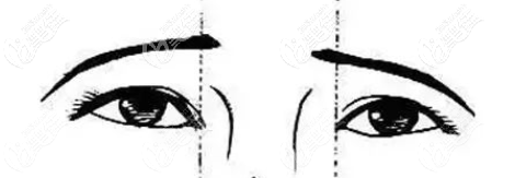 眼距较宽示意图