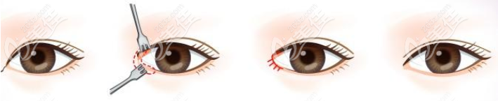内眼角手术过程示意图