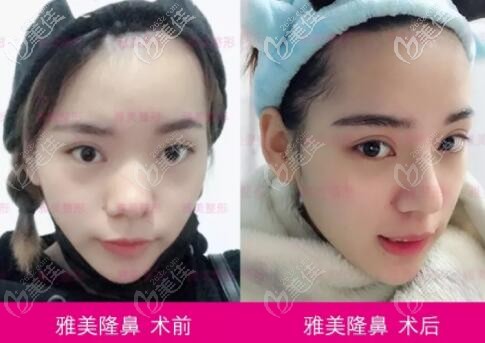 雅美隆鼻真人案例对比展示图 雅美隆鼻真人案例对比展示图