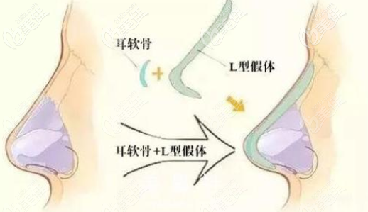 北京星灿宫王佳俊波德黄金三角美鼻术隆鼻效果示意图