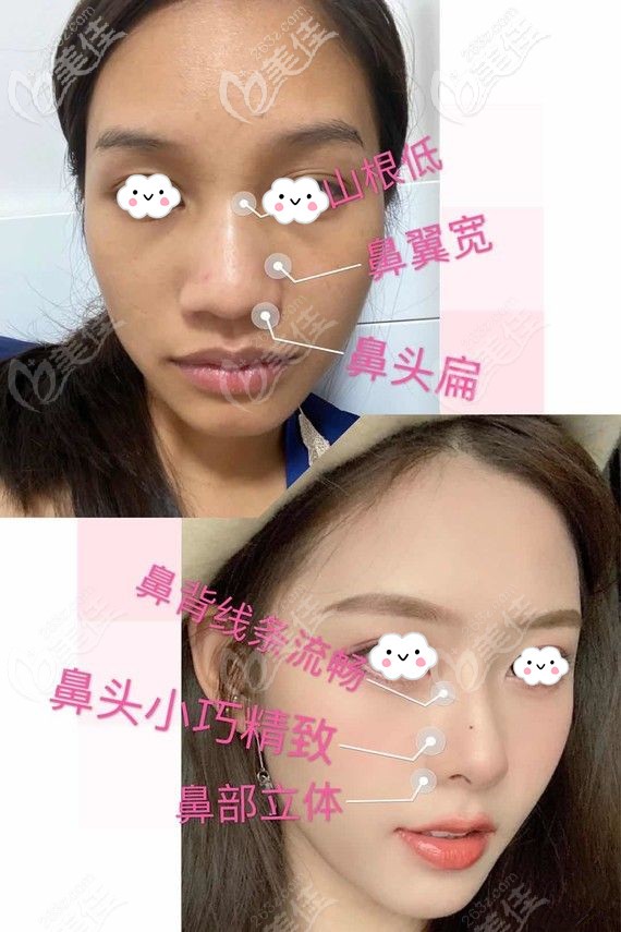 重庆军美鼻修复案例