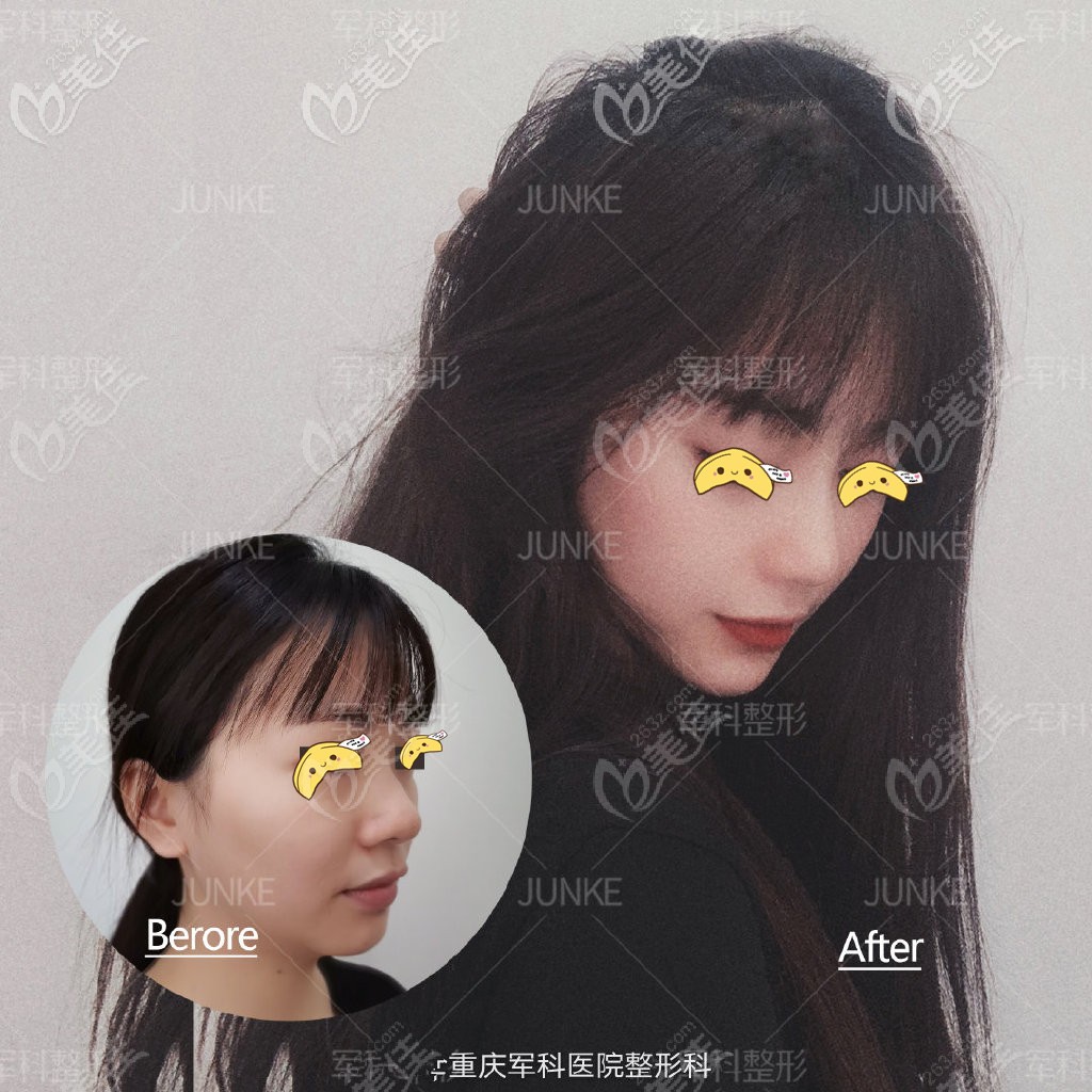重庆军科鼻修复案例