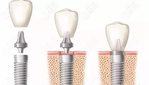 瑞士ITI种植系统