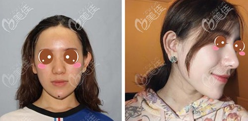 宁波薇琳肋软骨隆鼻案例 宁波薇琳肋软骨隆鼻案例