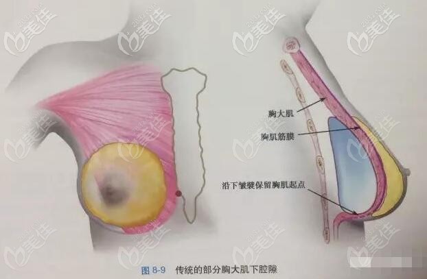 传统的胸大肌下放置隆胸假体 传统的胸大肌下放置隆胸假体