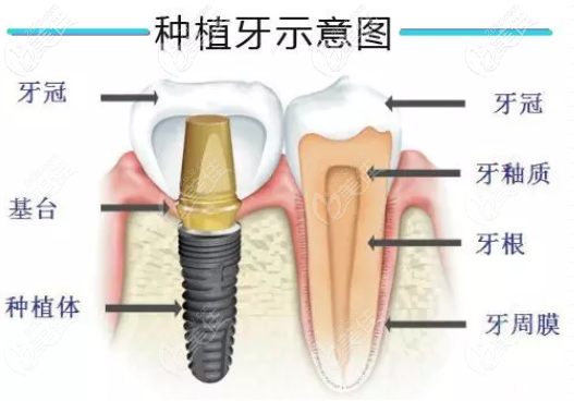 牙齿种植图示
