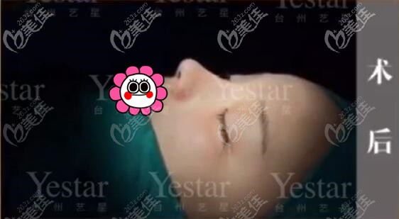 台州艺星李星星隆鼻术后即刻