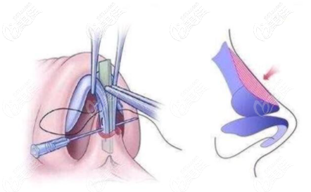 燕尾榫隆鼻示意图