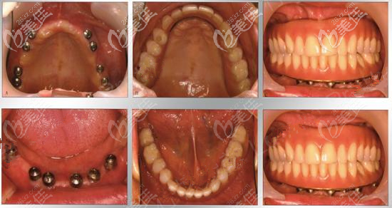 全口缺失、牙槽萎缩严重的他，在无锡维乐做韩国登腾种植牙修复后，坦言比义齿更耐用