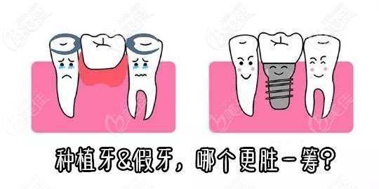 种植牙和假牙的对比