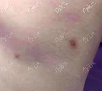 吸脂术后针眼发黑怎么治疗