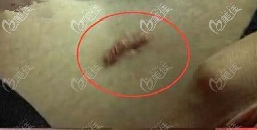 吸脂术后疤痕增生