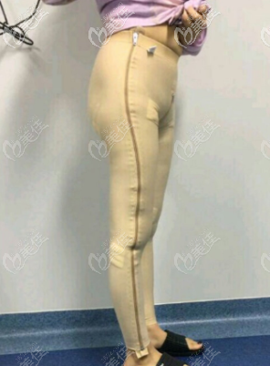 张勇医生给我做大腿吸脂术后当天照