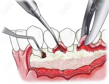 牙周翻瓣手术的原理