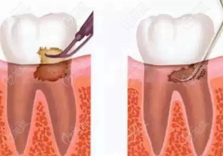 洗牙和龈下刮治术的区别