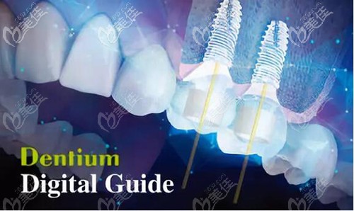 登腾种植体优势