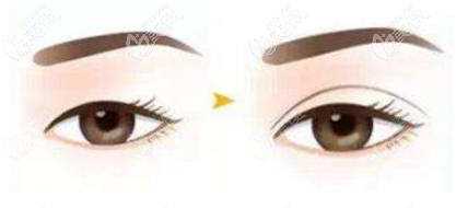 董国强医生切开双眼皮效果示意图 董国强医生切开双眼皮效果示意图