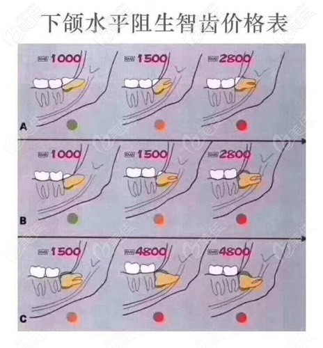 水平阻生智齿的参考价格