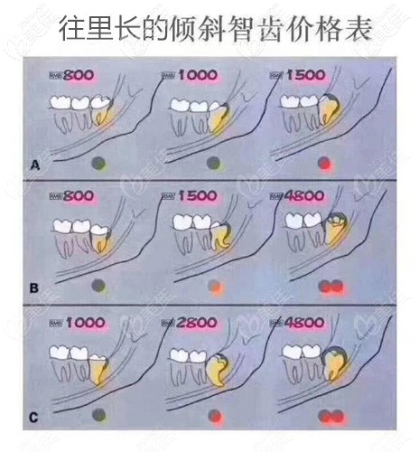 往门牙方向相反长的倾斜智齿参考价格