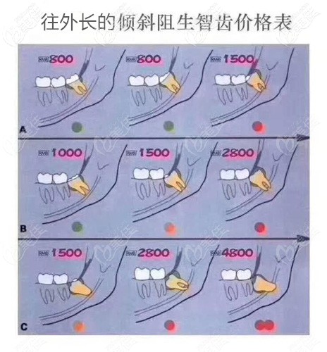 往门牙方向长的倾斜智齿参考价格