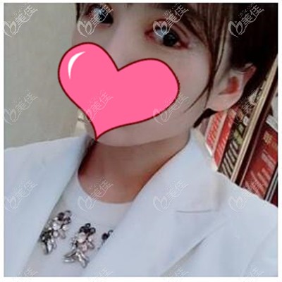 双眼皮术后7天 双眼皮术后7天