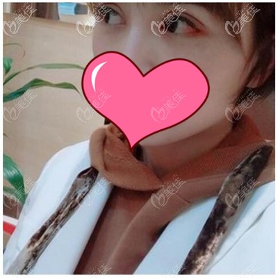 双眼皮术后1个月 双眼皮术后1个月