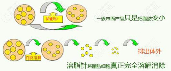采用溶脂的针剂改善颧骨高的情况