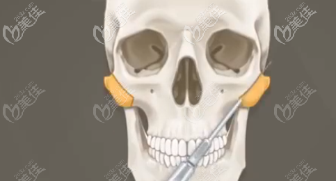 颧骨颧弓示意图 颧骨颧弓示意图