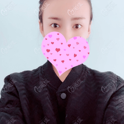 做全切双眼皮手术前 做全切双眼皮手术前