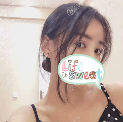 做霍格星眸全切双眼皮手术有一个月了 做霍格星眸全切双眼皮手术有一个月了