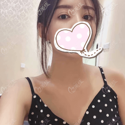 北京星灿宫医美机构全切双眼皮案例 北京星灿宫医美机构全切双眼皮案例