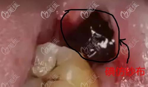 干槽症的治疗方法