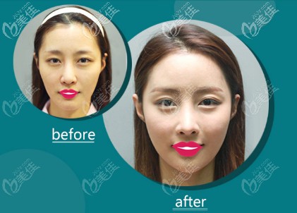 张宝成医生做埋线提升案例