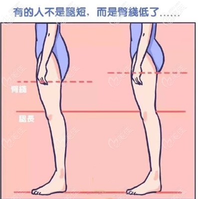 大腿抽脂包括臀线和臀部两侧